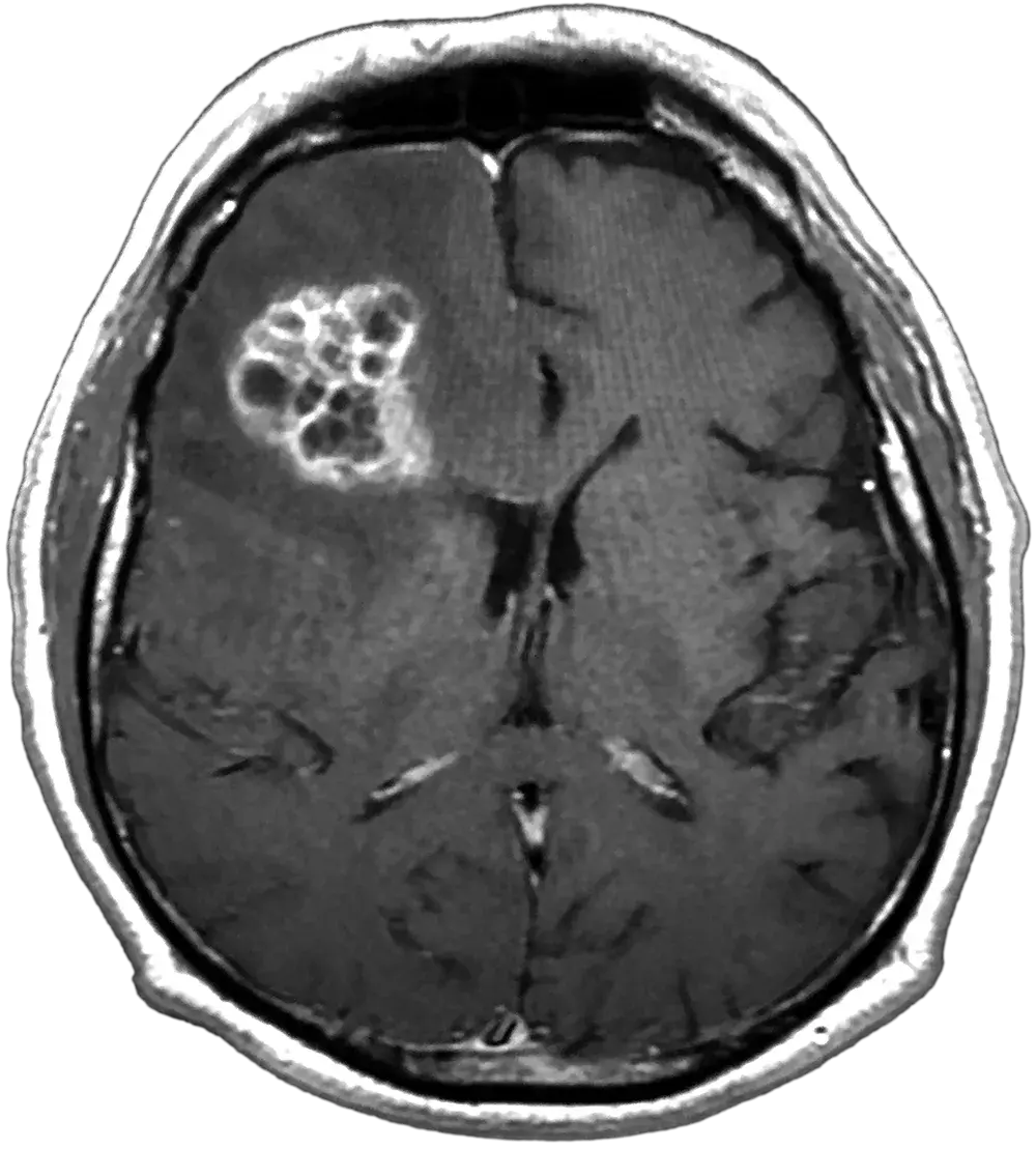 Frontal lobe MRI scan